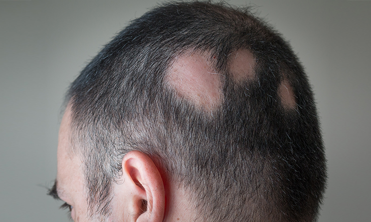What causes Alopecia Areata in Men?