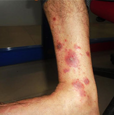 Psoriasis - Homeopathy Treatment results