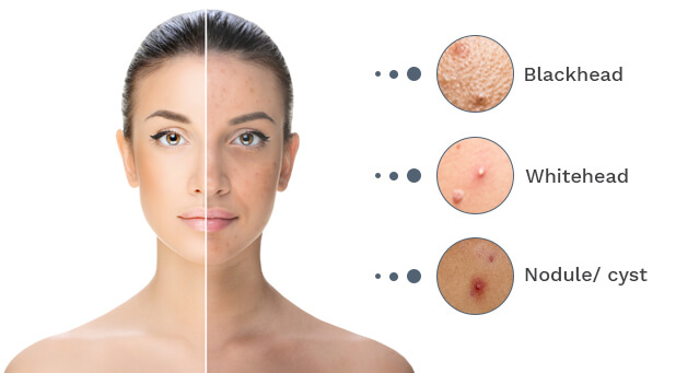 acne-pimple-images