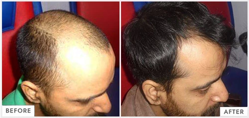 Dr Batras Hair loss Treatment Transplant Offers Coupons Regrowth Price